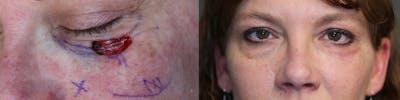 MOHS & Reconstruction Surgery Before & After Gallery - Patient 63017756 - Image 1