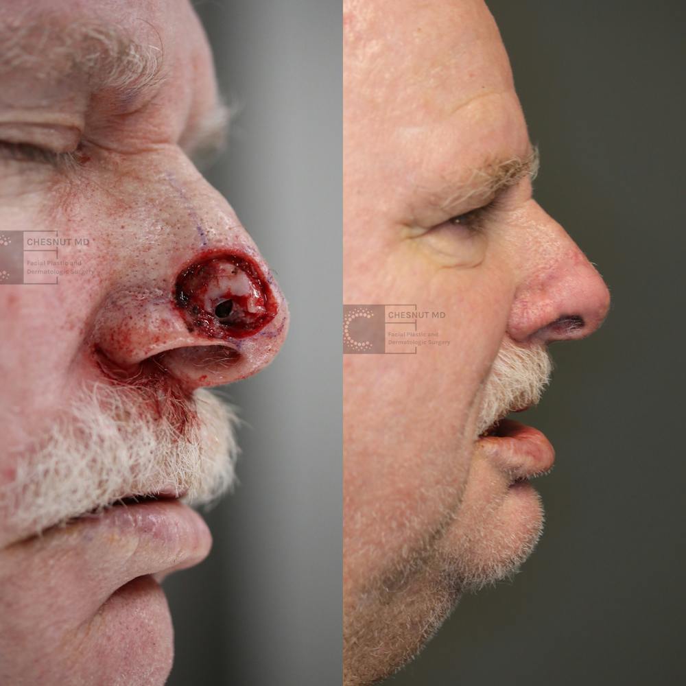 MOHS & Reconstruction Surgery Before & After Gallery - Patient 63017759 - Image 1