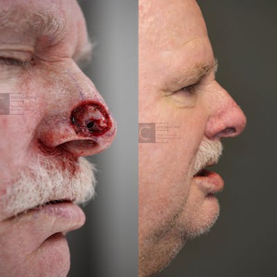 MOHS & Reconstruction Surgery Before & After Gallery - Patient 63017759 - Image 1