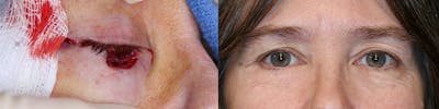 MOHS & Reconstruction Surgery Before & After Gallery - Patient 63017760 - Image 1