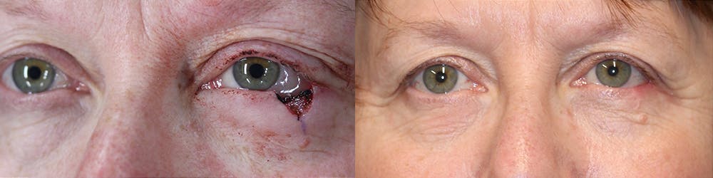 MOHS & Reconstruction Surgery Before & After Gallery - Patient 63017788 - Image 1