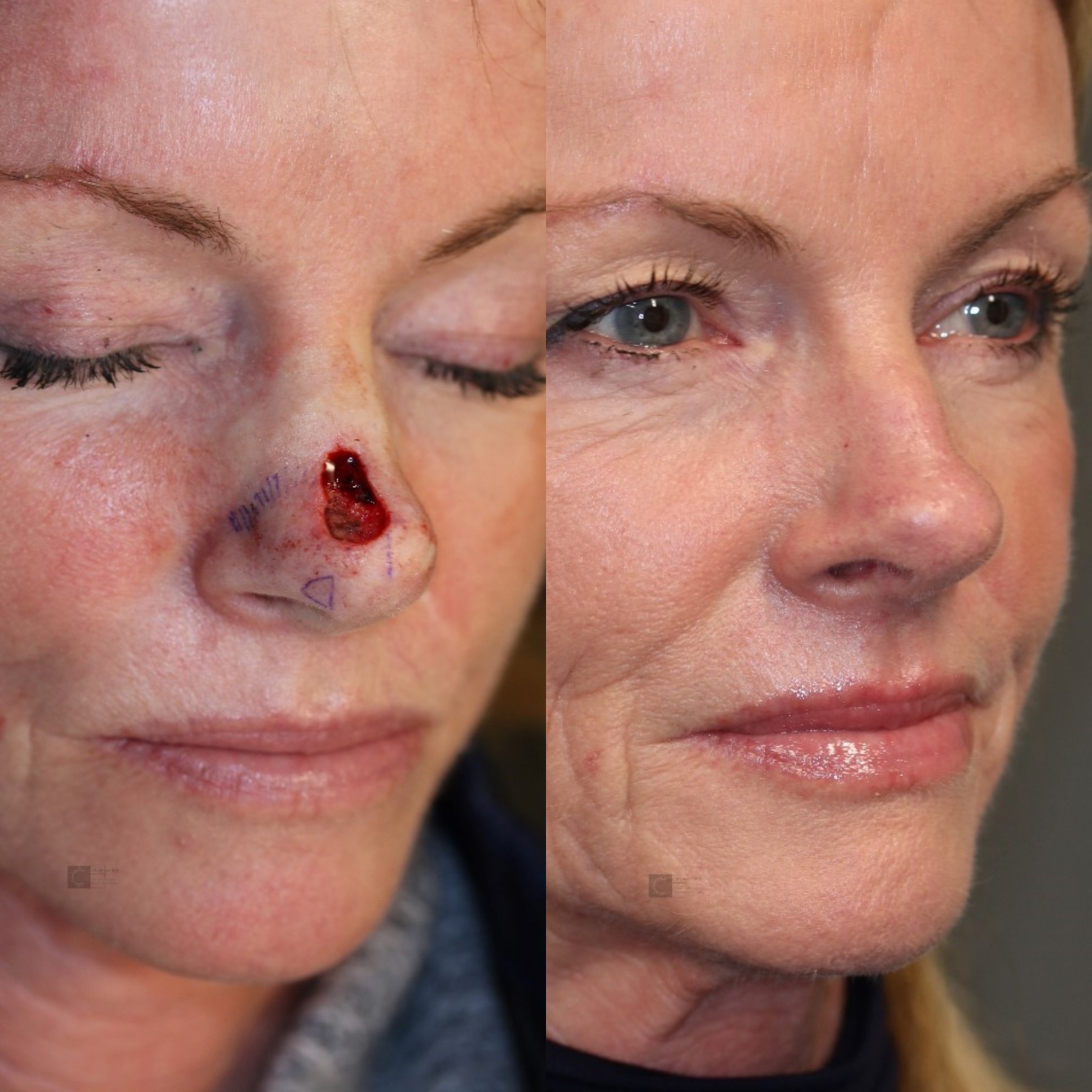 upper lip reconstruction 