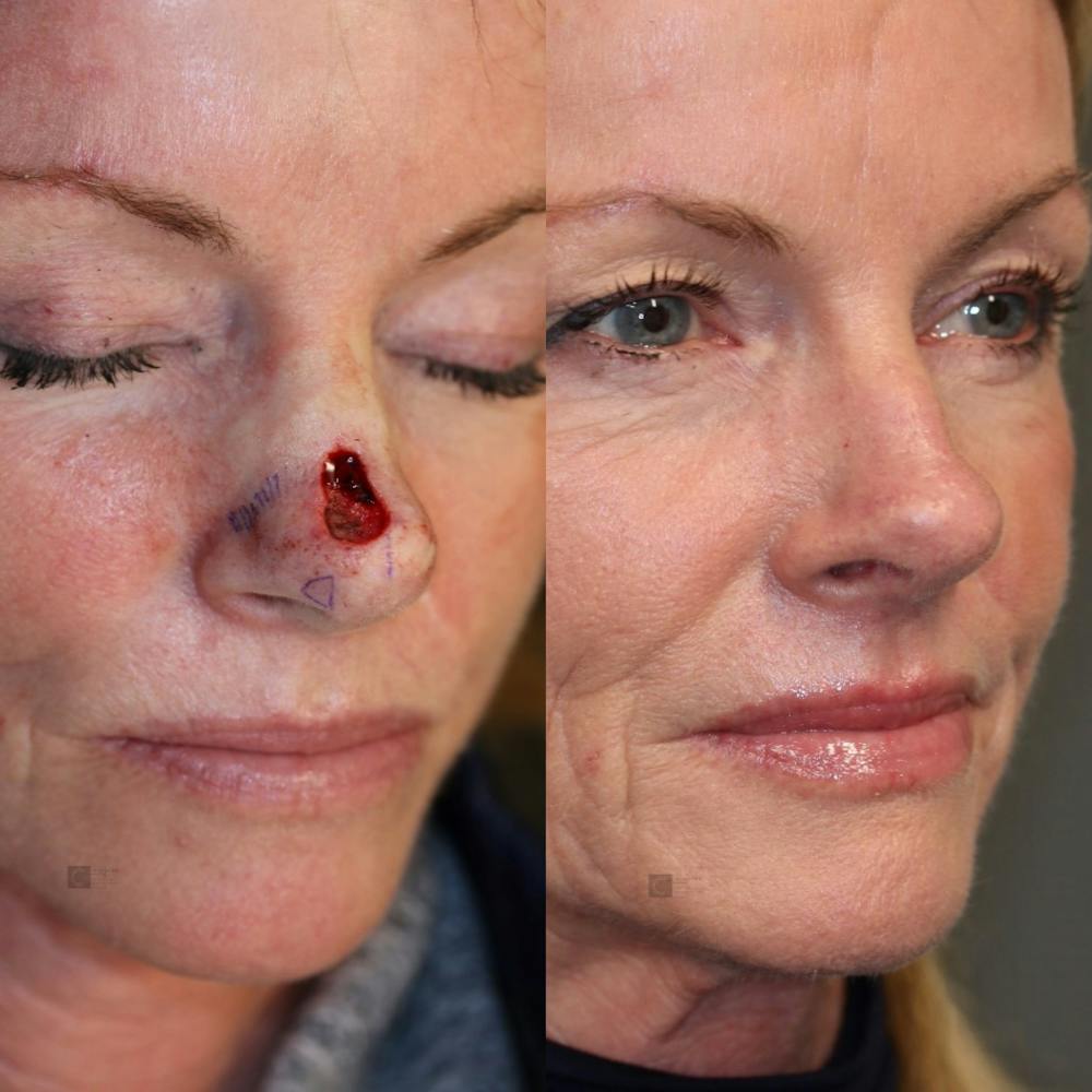 MOHS & Reconstruction Surgery Before & After Gallery - Patient 63017789 - Image 1