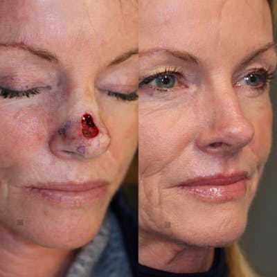 MOHS & Reconstruction Surgery Before & After Gallery - Patient 63017789 - Image 1