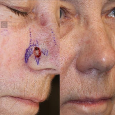 MOHS & Reconstruction Surgery Before & After Gallery - Patient 63017790 - Image 1