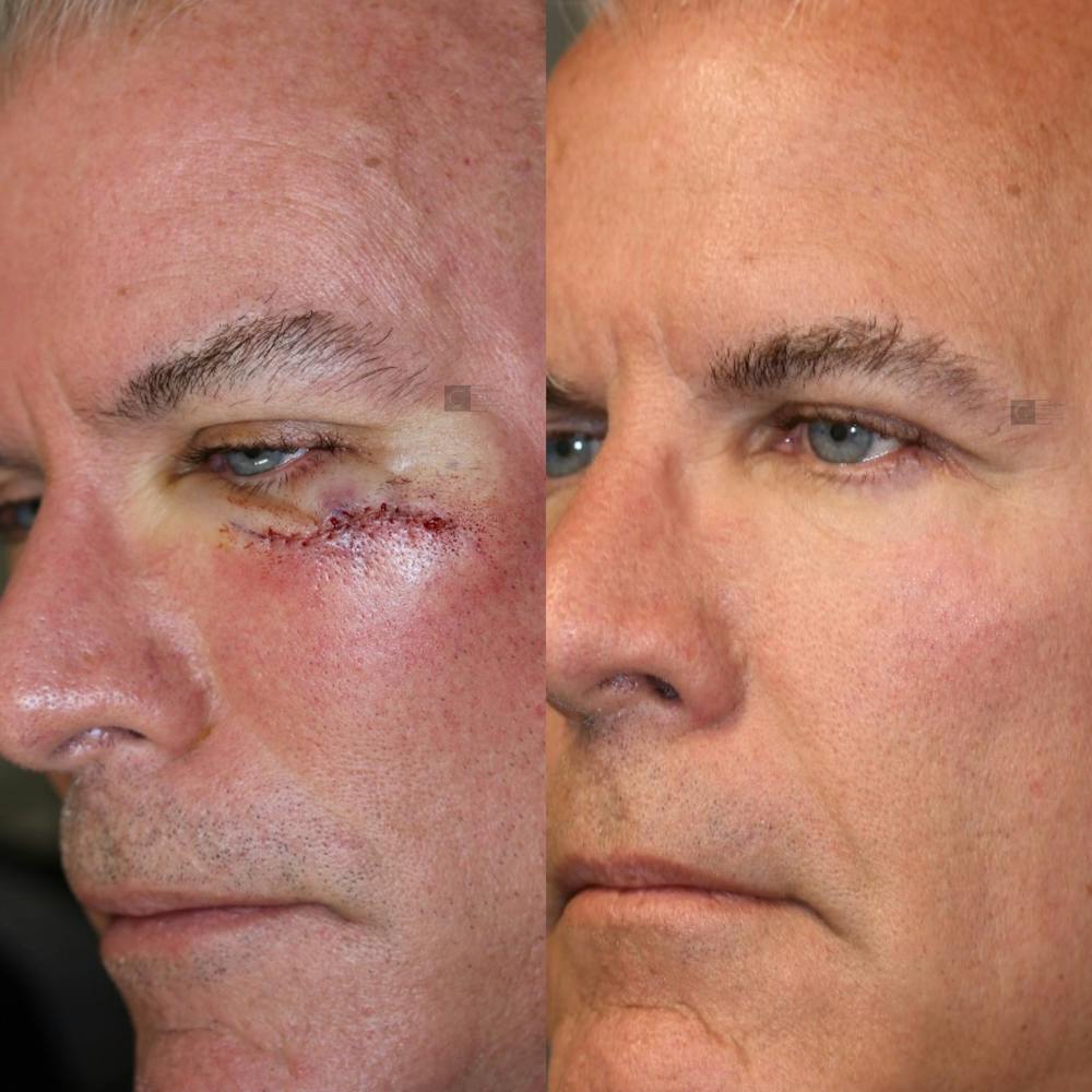 MOHS & Reconstruction Surgery Before & After Gallery - Patient 63017791 - Image 1