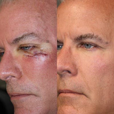 MOHS & Reconstruction Surgery Before & After Gallery - Patient 63017791 - Image 1
