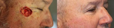 MOHS & Reconstruction Surgery Before & After Gallery - Patient 63017792 - Image 1
