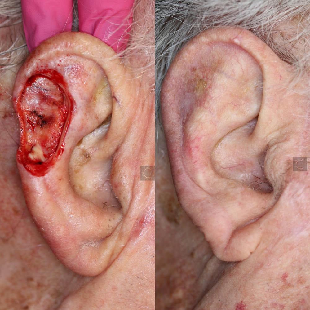 MOHS & Reconstruction Surgery Before & After Gallery - Patient 63017793 - Image 1