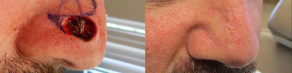 MOHS & Reconstruction Surgery Before & After Gallery - Patient 63017794 - Image 1