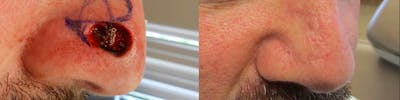 MOHS & Reconstruction Surgery Before & After Gallery - Patient 63017794 - Image 1