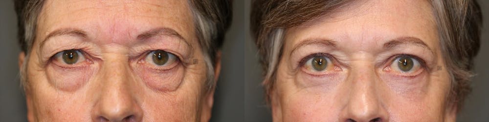 EnigmaLift - Eye Bag Removal Before & After Gallery - Patient 72492317 - Image 1