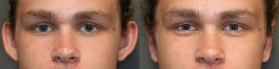 EnigmaLift - Earlobe Reduction Before & After Gallery - Patient 74253776 - Image 1