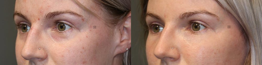 BOTOX, Dysport, Xeomin Before & After Gallery - Patient 74253781 - Image 1