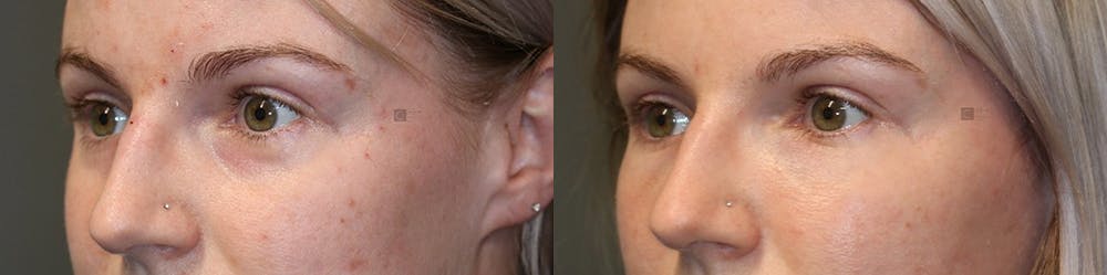 Dermal Fillers Before & After Gallery - Patient 74253788 - Image 1