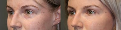 BOTOX, Dysport, Xeomin Before & After Gallery - Patient 74253781 - Image 1