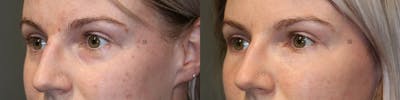 Dermal Fillers Before & After Gallery - Patient 74253788 - Image 1