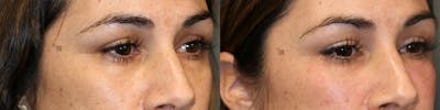 Dermal Fillers Before & After Gallery - Patient 74253793 - Image 1