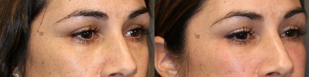 Dermal Fillers Before & After Gallery - Patient 74253793 - Image 1