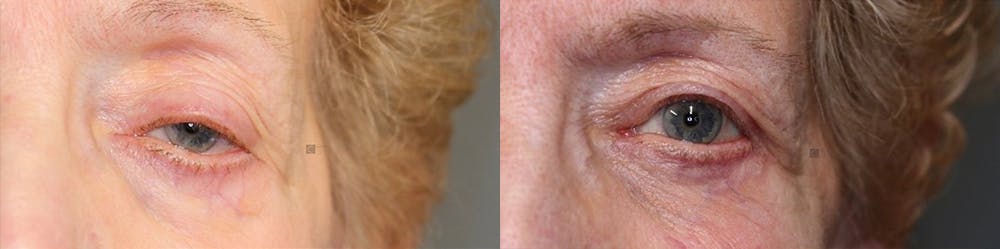  EnigmaLift - Upper Eyelid Surgery Before & After Gallery - Patient 74253813 - Image 1