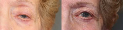  EnigmaLift - Upper Eyelid Surgery Before & After Gallery - Patient 74253813 - Image 1