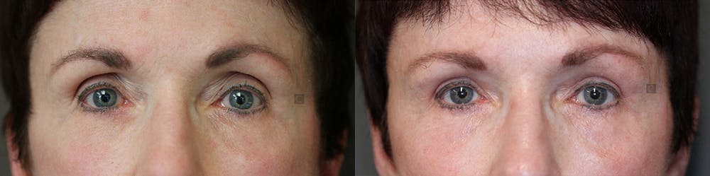 ÔPTIMized Facial Fat Transfer Before & After Gallery - Patient 74253871 - Image 1