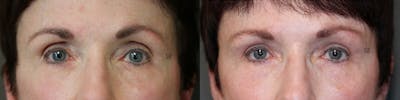 ÔPTIMized Facial Fat Transfer Before & After Gallery - Patient 74253871 - Image 1