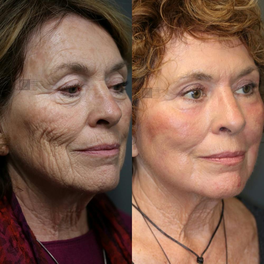 ÔPTIMized Facial Fat Transfer Before & After Gallery - Patient 74253906 - Image 1