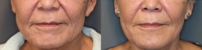 Facial Fat Transfer Before & After Gallery - Patient 74253936 - Image 1