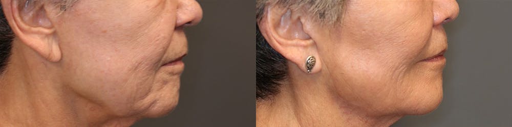 Regenerative Medicine Before & After Gallery - Patient 74253939 - Image 2