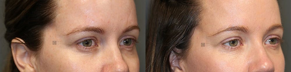 Dermal Fillers Before & After Gallery - Patient 74253962 - Image 1