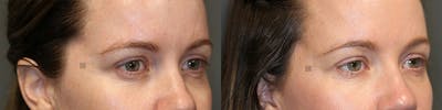 Dermal Fillers Before & After Gallery - Patient 74253962 - Image 1