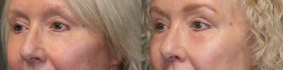 ÔPTIMized Facial Fat Transfer Before & After Gallery - Patient 74254028 - Image 1