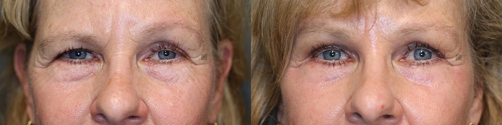  EnigmaLift - Upper Eyelid Surgery Before & After Gallery - Patient 74254557 - Image 1