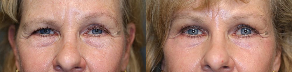 EnigmaLift - Brow Lift Before & After Gallery - Patient 74254561 - Image 1