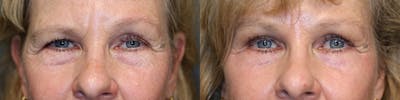 EnigmaLift - Brow Lift Before & After Gallery - Patient 74254561 - Image 1