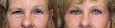  EnigmaLift - Upper Eyelid Surgery Before & After Gallery - Patient 74254557 - Image 1