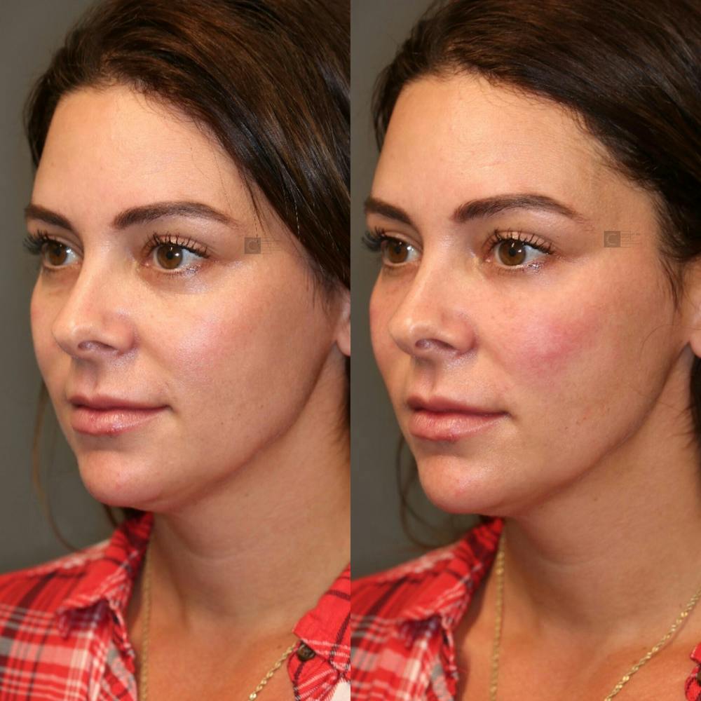 BOTOX, Dysport, Xeomin Before & After Gallery - Patient 75528469 - Image 2