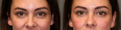 Dermal Fillers Before & After Gallery - Patient 75528458 - Image 2