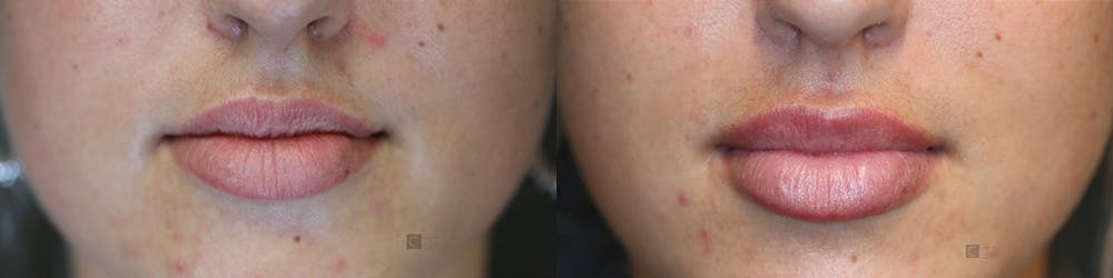 Dermal Fillers Before & After Gallery - Patient 75528493 - Image 1