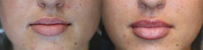 Dermal Fillers Before & After Gallery - Patient 75528493 - Image 1