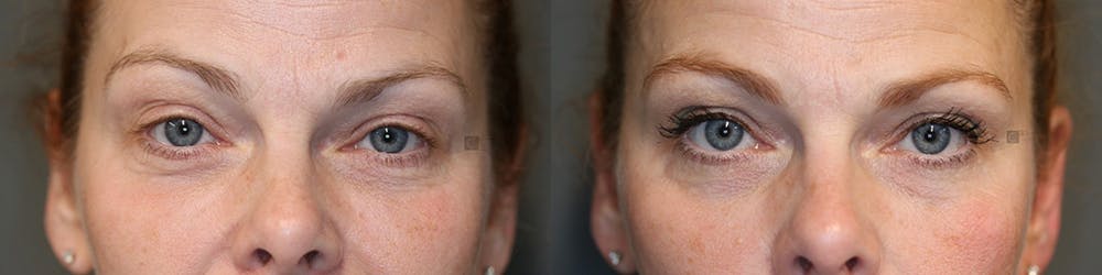 Patient 75528565 Wrinkle Relaxer Before And After Clinic 5c