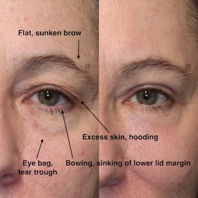 EnigmaLift - Eye Bag Removal Gallery - Patient 75528605 - Image 1
