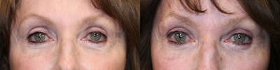 ÔPTIMized Facial Fat Transfer Before & After Gallery - Patient 75528626 - Image 1
