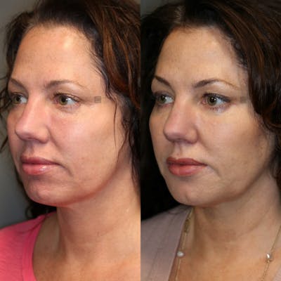 EnigmaLift - Eye Bag Removal Before & After Gallery - Patient 75528846 - Image 2