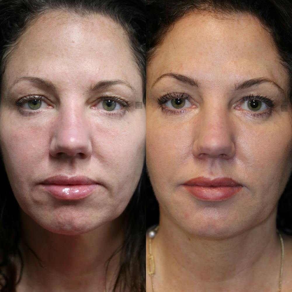 EnigmaLift - Eye Bag Removal Before & After Gallery - Patient 75528846 - Image 1