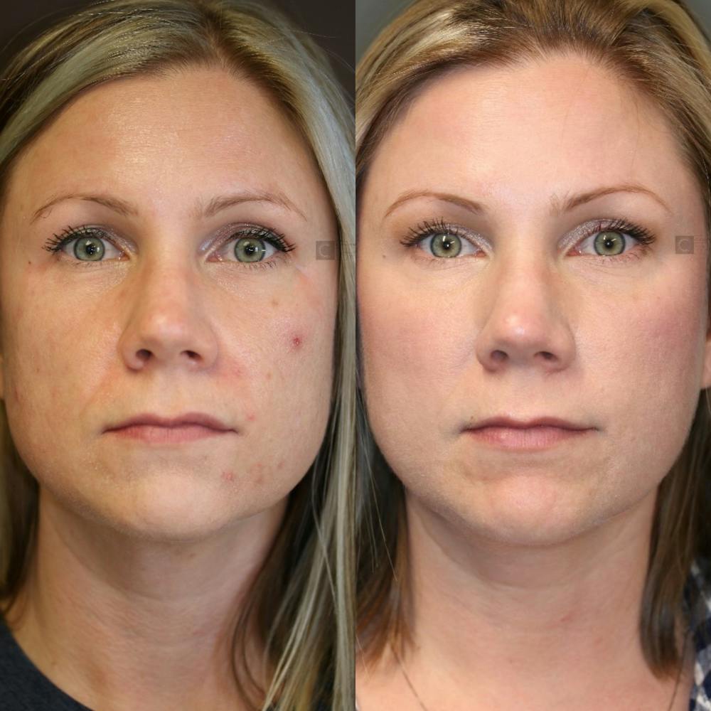 BOTOX, Dysport, Xeomin Before & After Gallery - Patient 75529270 - Image 1