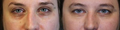 EnigmaLift - Eye Bag Removal Before & After Gallery - Patient 75529278 - Image 1