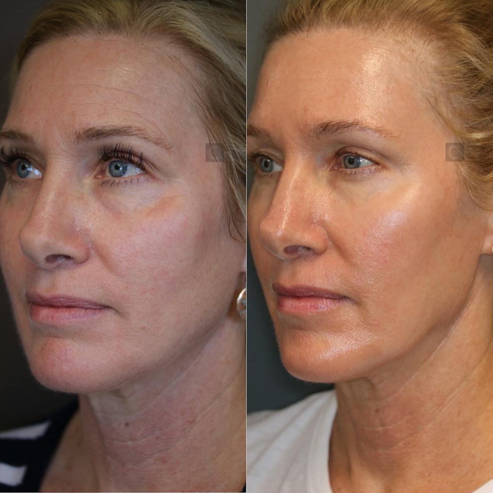 Dermal Fillers Before & After Gallery - Patient 75529353 - Image 1