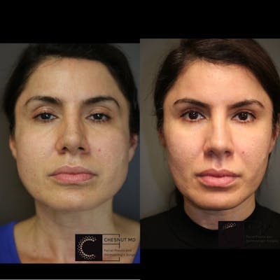 BOTOX, Dysport, Xeomin Before & After Gallery - Patient 75529411 - Image 1
